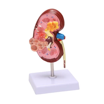 Obličkové Ochorenie Model Ľudského Tela, Anatómia Replika Choré Obličky Pre Lekárov Office Vzdelávací Nástroj Anatomicals